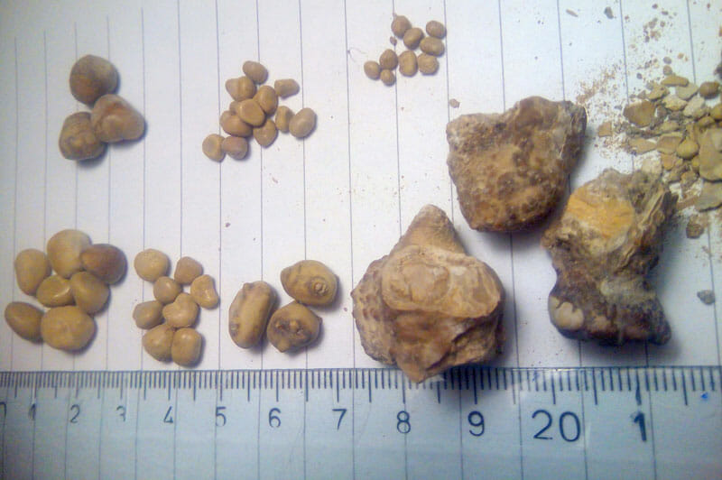 Kidney stones what are the symptoms? Harrogate Urology